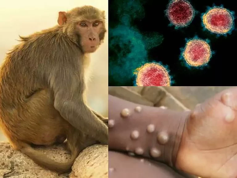 În Republica Moldova a fost înregistrat primul caz de variola maimuței