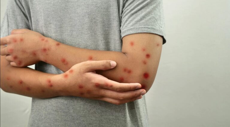 Un nou caz de rujeolă, depistat la un tânăr de 17 ani. Adolescentul nu a fost vaccinat